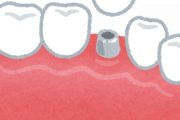 歯医者のインプラント（チタン製）7万円　ＶＳ　モノタロウのチタン製ネジ800円