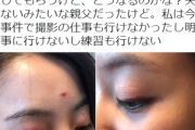 美人格闘家・山崎桃子、暴行被害の画像がヤバすぎる！ビール瓶で殴打され網膜剥離!?身長体重wikiプロフィール、傷跡写真まとめ！