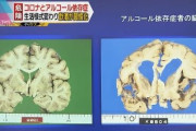 【悲報】アルコール健康障害の最新情報 多量飲酒は認知症リスクを高める　アルコール使用障害の悪影響を明らかにした研究が増える