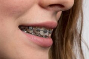 【画像】歯列矯正、ガチで凄すぎる