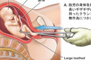 【グロ画像】中絶、実際の方法はめっちゃ残酷だった　中絶まんさんってただの人殺しだろ…