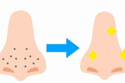【必見】いちご鼻をすっきり治す『この方法』がマジでスゴイｗｗｗｗｗｗｗｗｗ