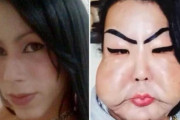 【地獄画像】手術代をケチって闇整形医にかかった女性、工業用シリコンを顔に注入された結果→ｗｗｗｗｗｗｗ