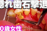 【朗報】歯石を取るだけの動画、なぜか2ヶ月で3569万回も視聴されてしまう…