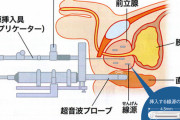 【画像】前立腺がんの治療、怖すぎる