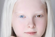 【画像】アルビノとオッドアイを併発した少女ｗｗｗｗｗｗｗｗｗｗｗｗｗｗｗｗｗｗｗｗｗｗｗｗｗｗｗ