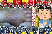 【2ch面白いスレ】蜂に刺された腕、腫れすぎてワロタwwww【ゆっくり解説】