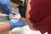 【動画】男さん、コックリングで玉が腫れがって手術で火花を散らしてしまうｗｗｗ
