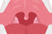 【緊急】扁桃腺切除手術したことある人、ちょっとコイｗｗｗｗｗｗｗ