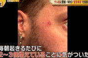 【画像】日本さん、今年に入りサル痘感染が急増してしまうｗｗｗｗｗｗｗｗ