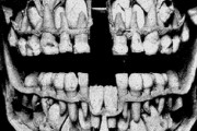 幼児の歯のレントゲン画像がヤバすぎる件