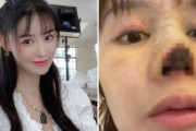 中国女優の高溜(ガオ・リュウ)さん、鼻整形後に壊死しちゃった
