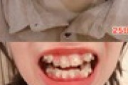 【画像】歯列矯正を3ヶ月ちょいやった結果がすごすぎる
