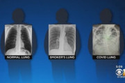 コロナ感染者の肺のレントゲン画像　喫煙者よりもヤバイと話題に