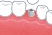 【緊急】インプラントってどうなんや？？