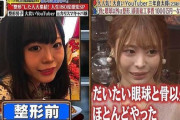 【画像】大人気ユーチューバーさん整形手術を告白　顔面総工事費1000万円