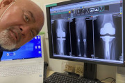 【画像】武藤敬司さん、膝のレントゲンがヤバすぎる・・・