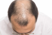 【画像】これってハゲる前兆なん？