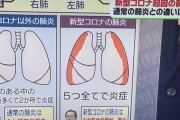 【画像】新型コロナ肺炎、普通の肺炎と格が違い過ぎた
