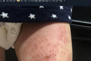 【悲報】自然派ママ「助けて！息子の足が治らないの (涙」